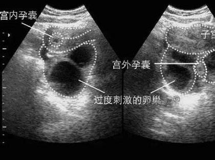 浙江省试管婴儿医院排名前十公开，附2026三代试管包孕费用明细